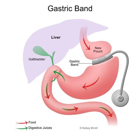 Gastric Band Removal - Toowoomba Bariatric Surgery, South-East QLD