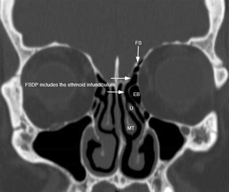 Ethmoid Sinus Hiatus Semilunaris