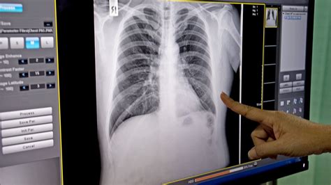 Emphysema Chest X Ray