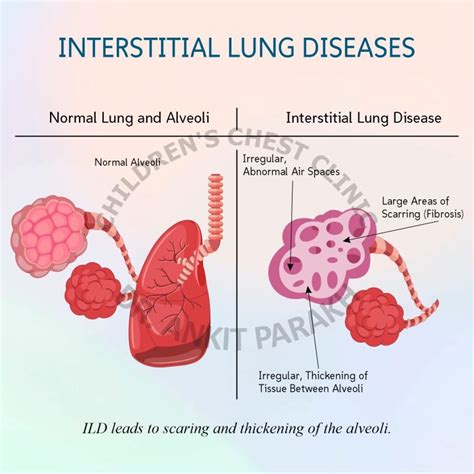 Childhood Interstitial Lung Diseases [chILD] - Dr. Ankit Parakh