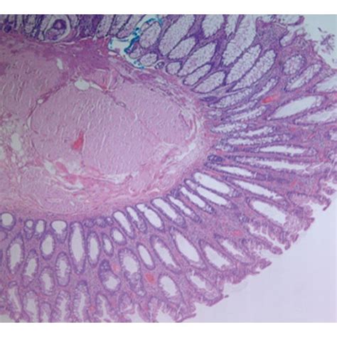 Colonoscopy showing a 10 mm sessile sigmoid colon polyp. | Download ...