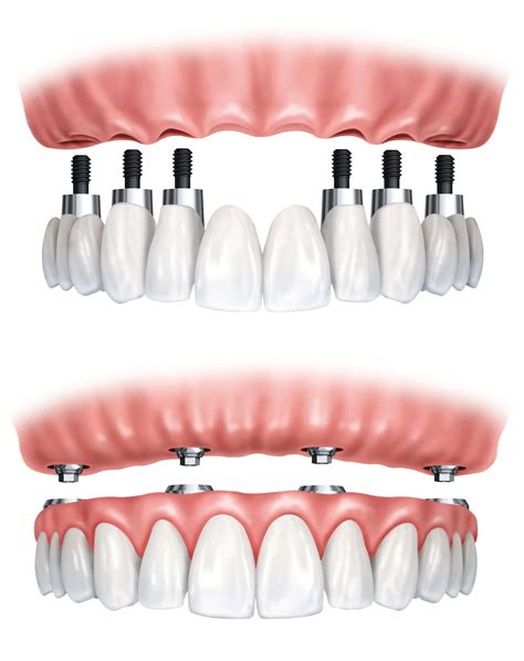 Traditional Dentures vs. Implant-supported Dentures - Skillman, NJ