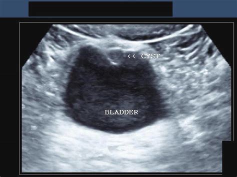 A Gallery of High-Resolution, Ultrasound, Color Doppler & 3D Images - Urinary bladder