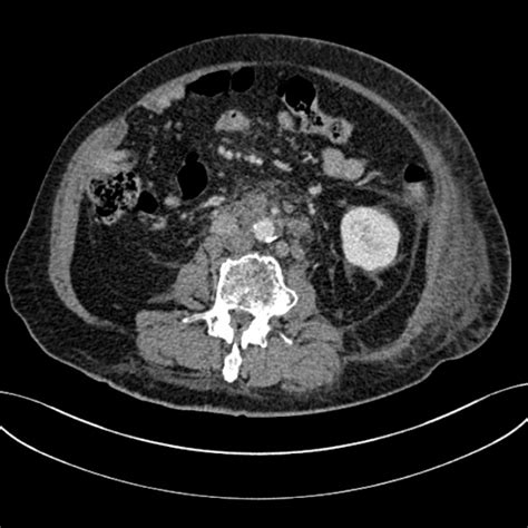 Para Aortic Lymphadenopathy Differential Diagnosis