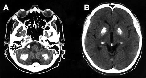 Extensive brain calcifications in systemic sclerosis: two cases -- BLANCO et al. 67 (5): 697 ...