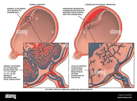 Normal Anatomy of the Placenta vs. Placental Abruption Stock Photo ...