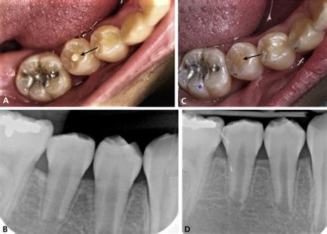 Dens evaginatus - The Journal of the American Dental Association