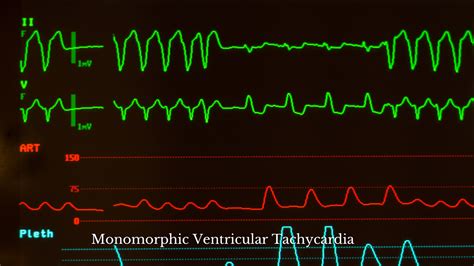 Monomorphic Vs Polymorphic Ventricular Tachycardia