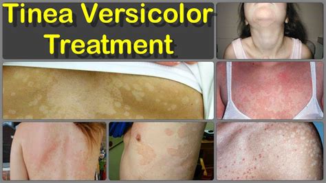 Top 10 Tinea Versicolor Treatment Options That Really Work Naturally - YouTube