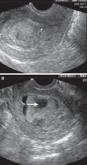 Abnormal Development - Hydatidiform Mole - Embryology