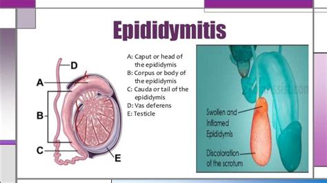 Orchitis & epididymitis