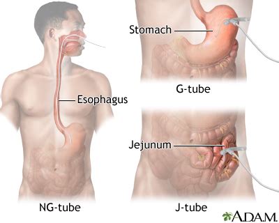 Tube feeding: MedlinePlus Medical Encyclopedia Image