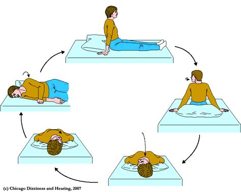 Home Epley Maneuver Diagram