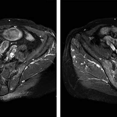 Magnetic resonance imaging (MRI) of the sacroiliac joints showed ...