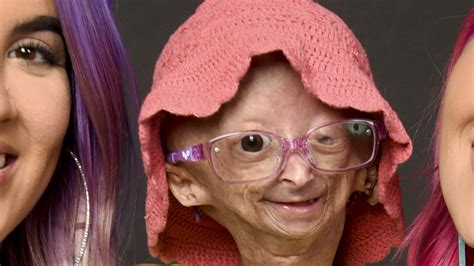 Adalia Rose: Social media star with rapid aging condition dies at 15 | WGN-TV