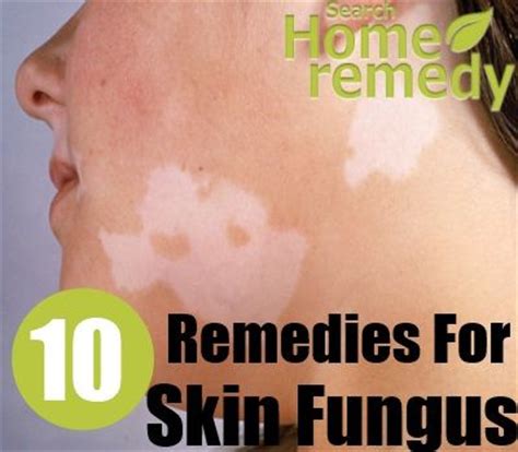 1000+ images about Skin fungus on Pinterest | Skin problems, Argan oil and Home health