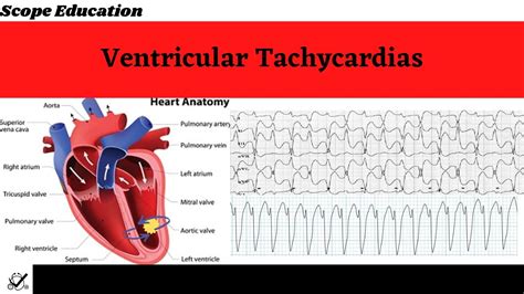 Ventricular Tachycardia Symptoms