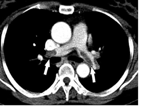 File:Pulmonary embolism.jpg - Wikimedia Commons