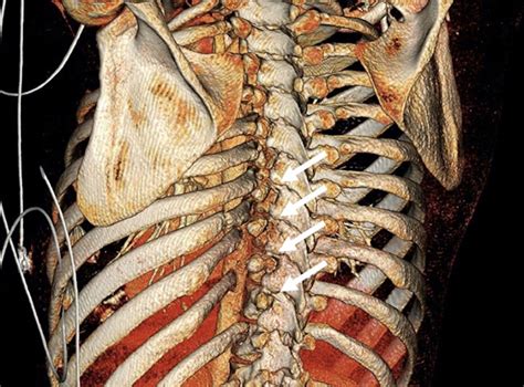 Costovertebral Ligament