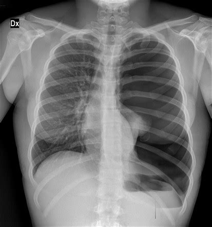 Spontaneous pneumothorax - pulmonary blebs | Radiology Case ...