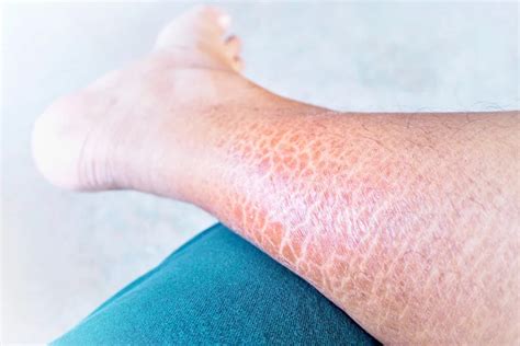 Ichthyosis Vulgaris: Causes, Symptoms, and Treatment