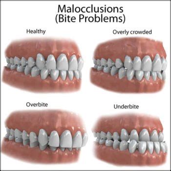 Types of Malocclusion and Correction - Winchester Dental