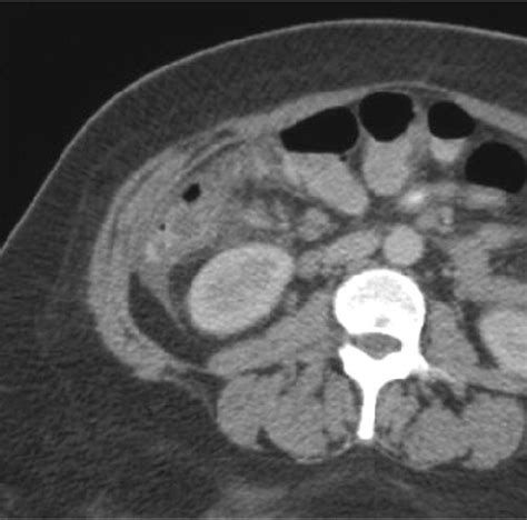 CT of a perforated appendix in a 33 yr. old pregnant female who... | Download Scientific Diagram