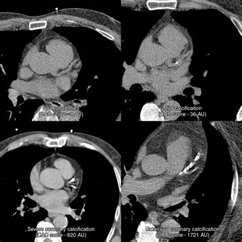 Coronary Artery Calcification: Pathogenesis, Imaging, and Risk ...