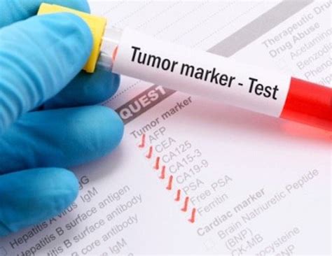 Liquid biopsy for lung tumor: minimally invasive procedure