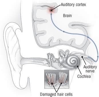 Tinnitus: Ringing in the ears and what to do about it - Harvard Health