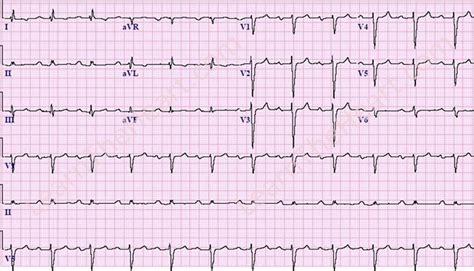 First Degree AV Block ECG 5 | LearntheHeart.com