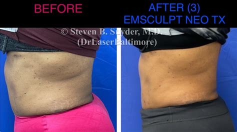 Emsculpt NEO Before and After Gallery - Dermatology Laser Center & Medispa