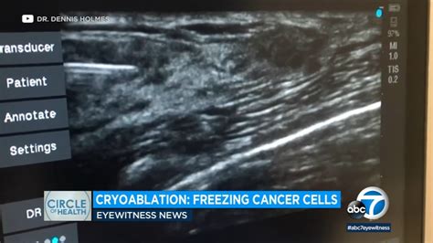 Freezing away earlier stages of breast cancer? How Cryoablation could ...