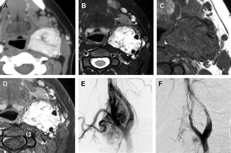 Paragangliomas of the Head and Neck | Radiology Key