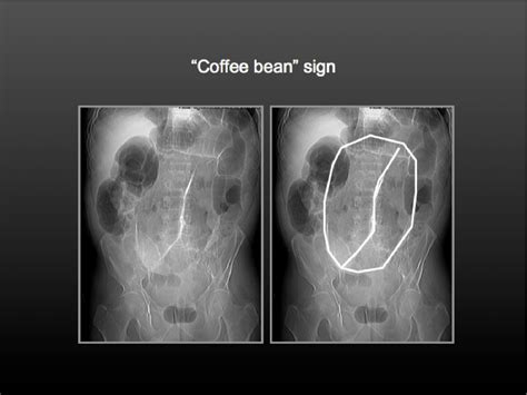 Cecal Volvulus X Ray Coffee Bean