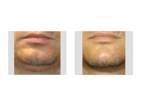 chin cleft reduction Archives