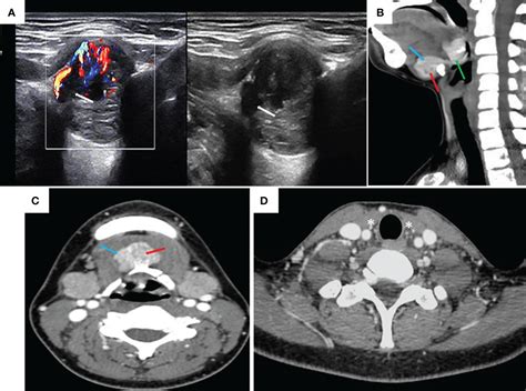 Frontiers | Diagnosis and treatment of ectopic thyroid carcinoma: A case report and literature ...