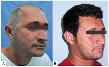 RBCP - Cranioplasty: parietal versus customized prosthesis