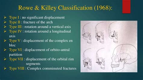 Zmc fractures part 1