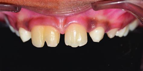 Tooth preparation for veneer | Download Scientific Diagram