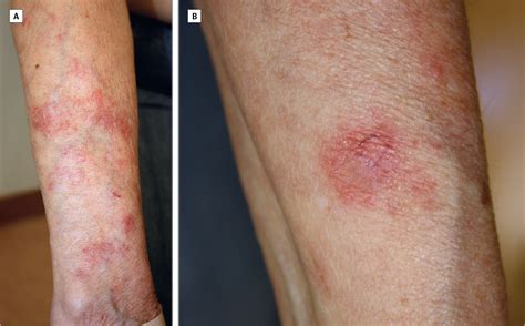 Subacute Cutaneous Lupus Erythematosus | Dermatology | JAMA Dermatology | The JAMA Network