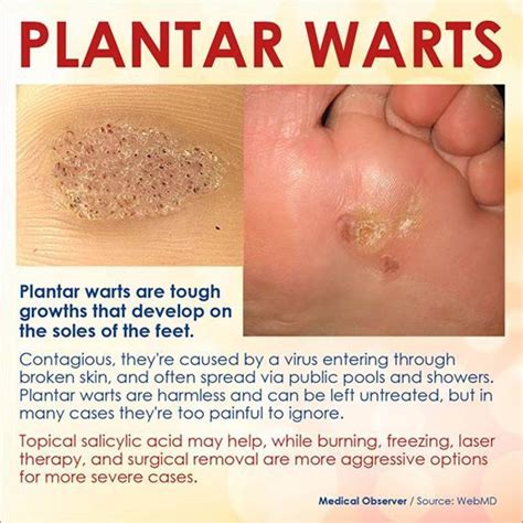 Plantar Warts | Health,Fitness,Dietary | Pinterest