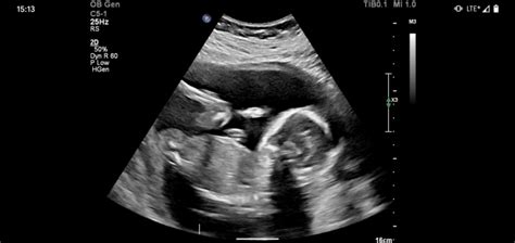 Baby Girl at 20 Week Ultrasound | BabyCenter