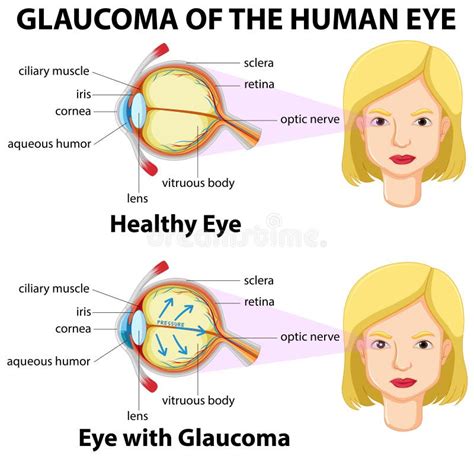 Glaucoma of the human eye stock vector. Illustration of woman - 73719207