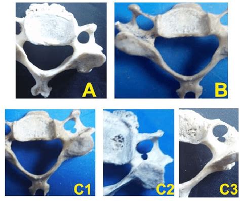 A: Circular type Foramen Transversarium. 1B: Elliptical type Foramen ...