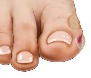 Foot Blister | Symptoms & Treatment | Florida Foot Ankle