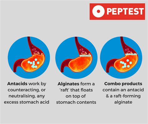 Alginate antacids for treating reflux: a medication comparison study