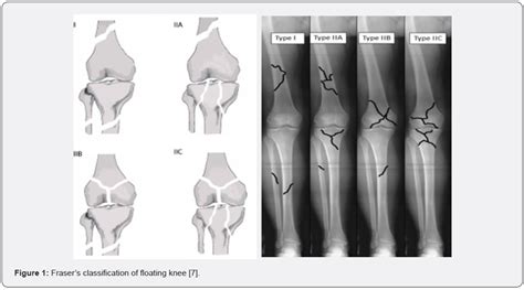 An overview of Floating Knee Injuries, Management Approach