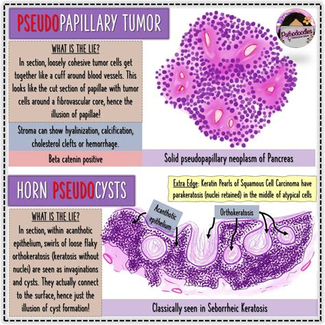 Keratin Pearls Vs Psammoma Bodies