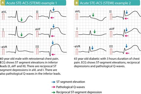 ECG signs of myocardial infarction: pathological Q-waves & pathological ...